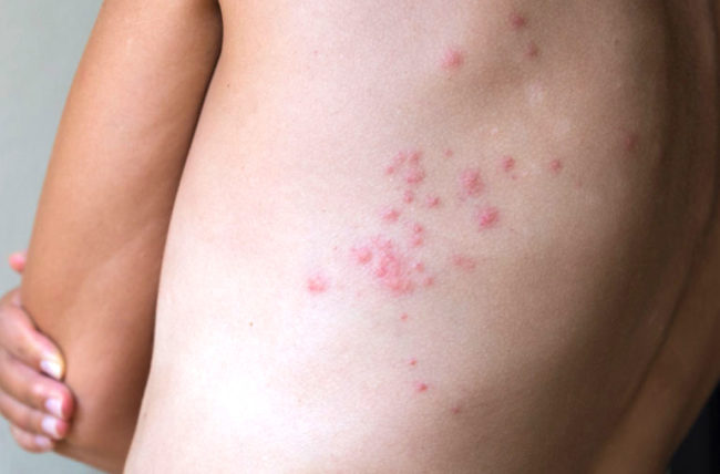 Bed Bugs Control